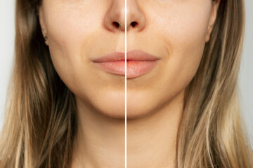 Lip Filler